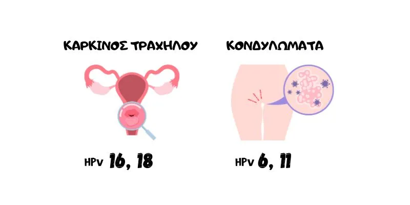 Infographic: Ο HPV 16 & 18 συνδέονται με καρκίνο τραχήλου, ενώ ο HPV 6 & 11 με κονδυλώματα.