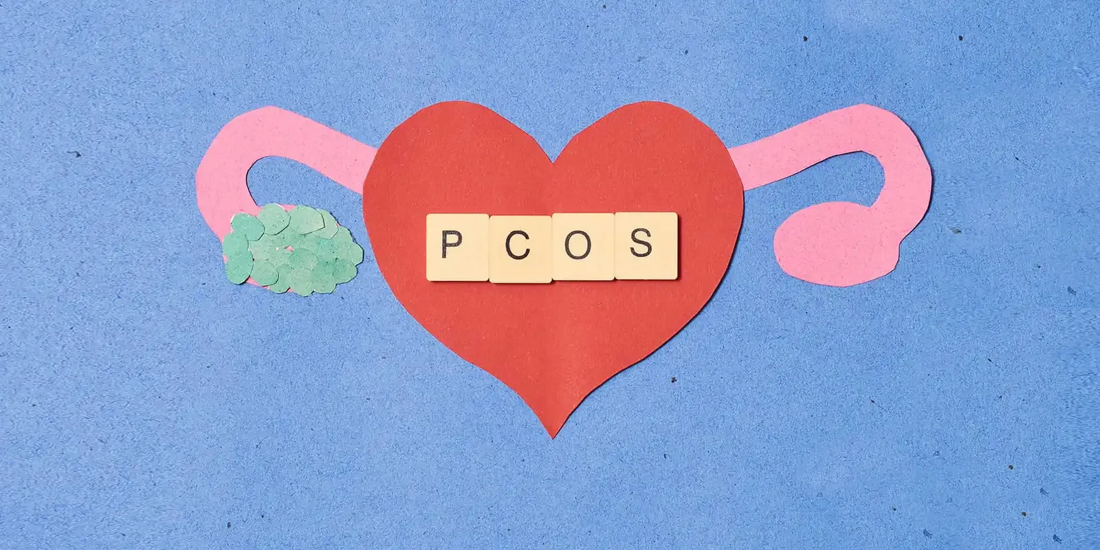 Polycystic ovaries, infertility and miscarriages